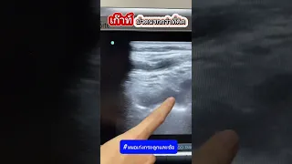  ทำไมข้อเท้าถึงบวมและมีสีดำคล้ำ พร้อมกับเจ็บเวลาเดิน 