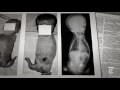 The Shadow of the Thalidomide Tragedy Retro Report The New York Times
