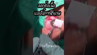 กาวชีวภาพที่ใช้ในการลอกตอนเหนือคืออะไร และมีจุดประสงค์อย่างไร