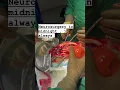 Download Lagu Brain Bleed, Brain Hemorrhage Surgery, Treatment by Neurosurgeon in Adajan, Surat.