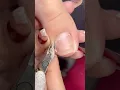 Lots of cuticles and dry skin