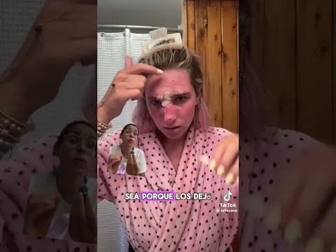 Acné GRAVE #acne