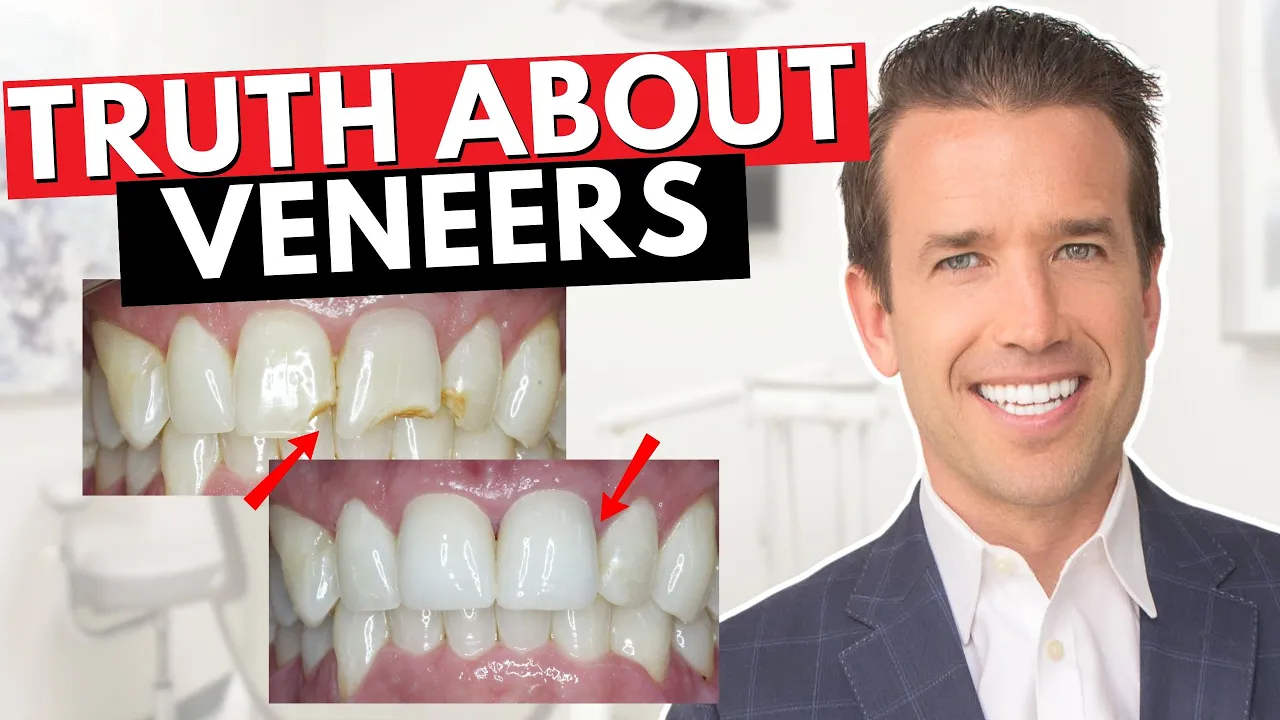 Outline Video Before you get Dental Veneers Watch This! | Are Veneers Worth It?