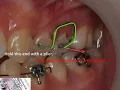 Rectangular loop lateral activation