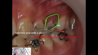 Rectangular loop lateral activation