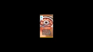 انیمیشن جراحی مغز   مراحل عمل تومور مغزی به زبان ساده  سلامت                      دندنها