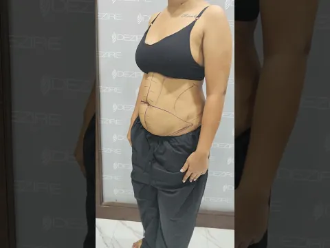 Tummy Tuck Result