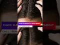 Download Lagu Hair Dandruff Treatment Will Make You Tons Of Cash.Here's How! #hair_dandruff_tretmant #skinaaclinic