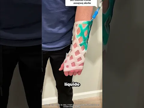 ¡Este nuevo yeso resuelve el peor problema de tener un brazo roto! 😳🦴