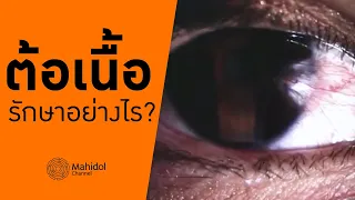 วิธีป้องกันต้อเนื้อให้ไม่แย่ลงคืออะไร