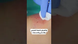أسباب بسيطة وأخرى خطيرة تقف وراء عدم شفاء الجروح عليك معرفتها  أسباب بسيطة وأخرى خطيرة تقف وراء عدم شفاء الجروح عليك معرفتها