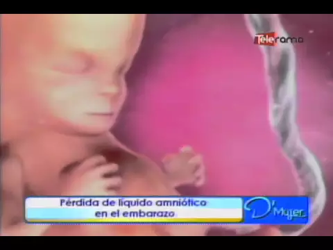 Pérdida de líquido amniótico en el embarazo