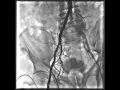 Download Lagu Balon angioplasty arteri dari ekstremitas bawah