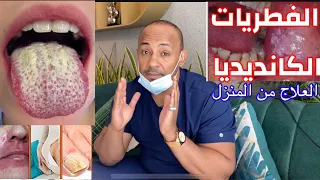 ١ اقتل كل الفطريات الي في جسم من المنزل اعراض و علاج الكانديديا علاج الكانديديا بالاعشاب دندنها