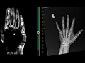Metallic susceptibility artifact on MRI