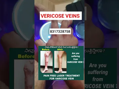 vericose veins best in kannada #kannada