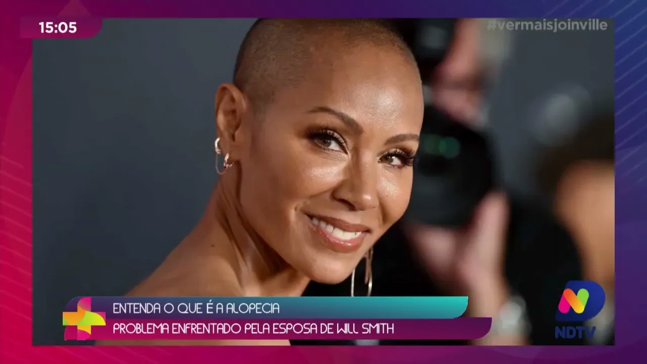 Alopecia: entenda a doença da mulher de Will Smith