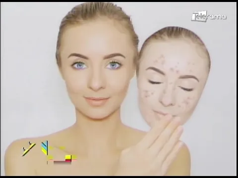 Acné en los adultos