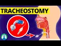 Tracheostomy Medical Definition Quick Explainer
