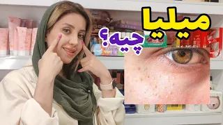درمان میلیا  راهنمای کامل برای خلاص شدن از شر این دانه های سفید پوستی دندنها