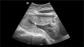 Cinco complicações de cesariana diagnosticadas pela ultrassonografia