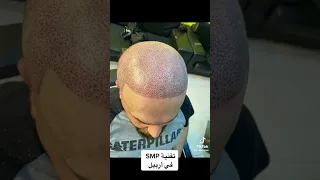 تقنية SMP رسم الشعرة المجهرية 