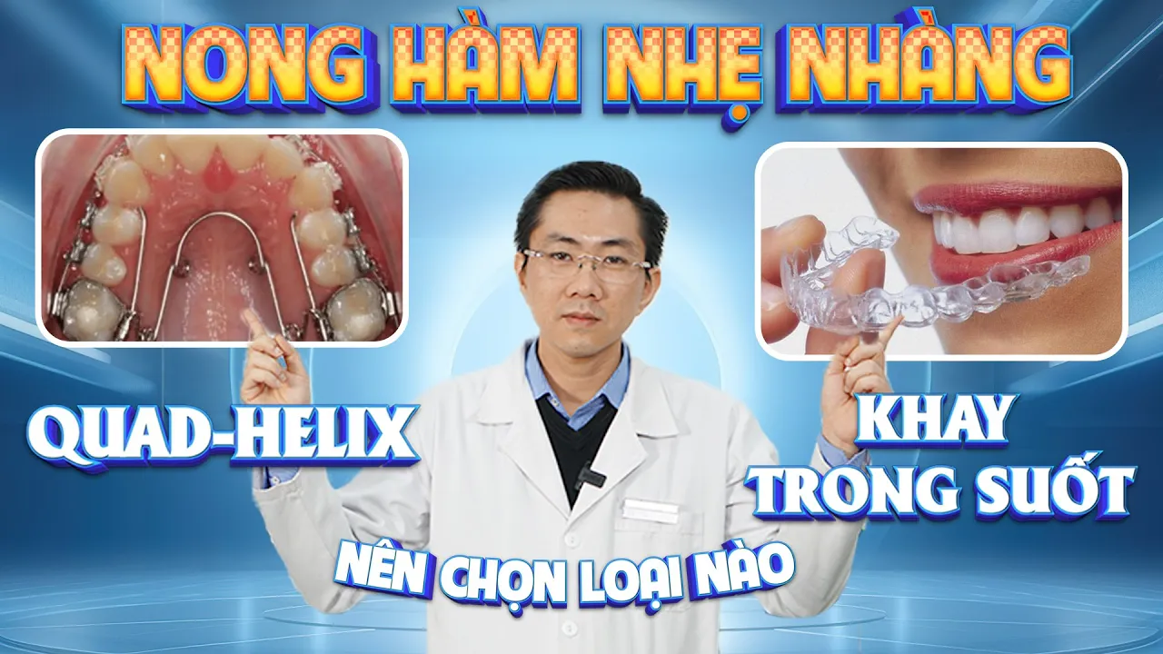 Outline Video Nong Hàm Chỉnh Nha - Nên Chọn Loại Nào? | Nam Bùi Vinalign