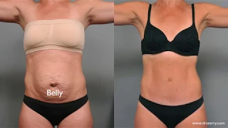 Tummy Tuck Scar Evolution NYC Plastic Surgeon Dr Sterry Explains