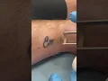 Download Lagu First session of laser tattoo removal #lasertattooremoval #satisfying #tattoo #breakup