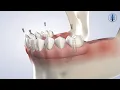 Full-Arch Restoration in Lubbock TX Hill Ioppolo Oral Dental Implant Surgery of Lubbock