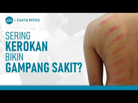 Hobi Kerokan, Bikin Sehat atau Sakit?