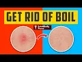 How to Get Rid of a Boil the Right Way Scientifically Proven