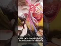Download Lagu Samurai (the Direct True Lumen Technique) Cannulation in Acute Type I Aortic Dissection #Cardiac