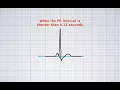 Interpreting ECG duration