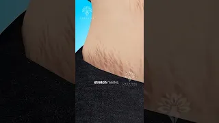 Why Do Stretch Marks Really Happen Surgeon Reacts