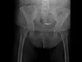 Retrospective Hysterosalpingogram (HSG) X-Ray Exam: View of Uterus and Fallopian Tubes