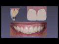 Cosmetic Dentistry and Smile Design - Porcelain Veneers: Tooth Reduction