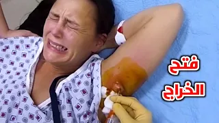 خراج تحت الابط Axillary Abscess 