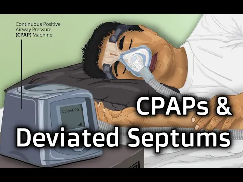 Download MP3 CPAPs and Septal Deviations