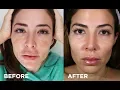 Download Lagu How I Got Rid of Melasma On My Face | My Clear + Brilliant Experience | Bianca Jade