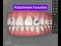 Invisalign Conventional Attachment Favorites