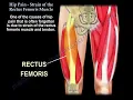 Hip Pain Strain Of The Rectus Femoris anatomy of the rectus femoris