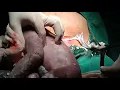 Download Lagu Caesarean section with  breech delivery- Dr Rahul Jadhao