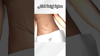 عملية زراعة الكلى 