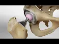 Total Hip Replacement 3D Animation