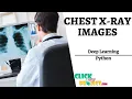 Python DeepLearning Project Chest X-Ray Images to Improve Screening Iterated Function-ClickMyProject