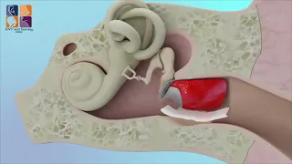 كيفية إصلاح ثقب طبلة الأذن 