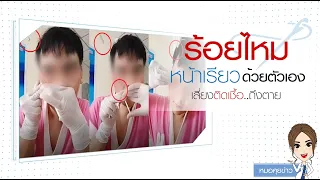 ทำไมการร้อยไหมที่บ้านจากคำแนะนำใน YouTube ถึงอันตราย