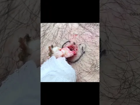 Tough Calcified Cyst Extraction