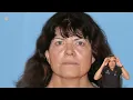 Preservation Deep Plane Face & Neck lift - Case Study